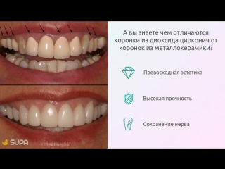 Как выглядят зубы из металлокерамики